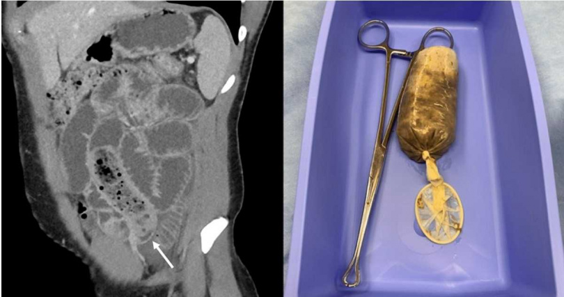 據《Cureus》刊登的照片中可以看到，透過手術取出的保險套和手術鉗均呈現黃色，因為保險套內部的香蕉已軟爛成泥，必須在底部打結才能避免流出。（圖／翻攝自Cureus.com）