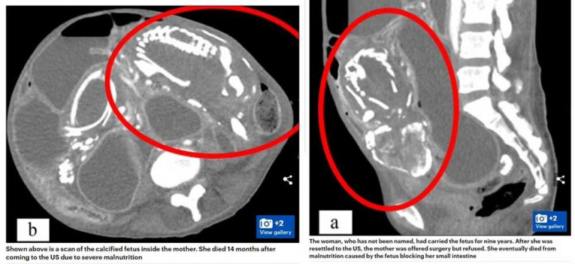 女子腹中死嬰鈣化後形成「石胎」，連骨架都能明顯看見。（圖／翻攝自Dailymail）