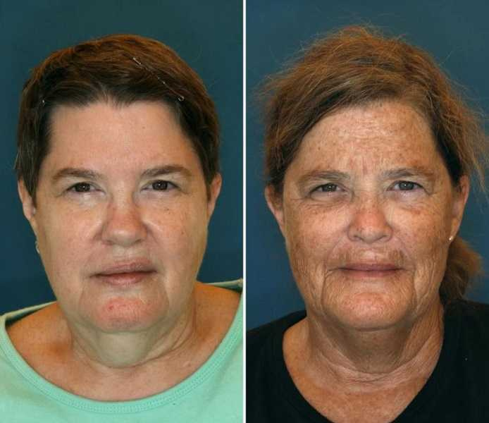 珍妮（左）和蘇珊（右）都是61歲，但皮膚狀況差很多。（圖／翻攝自Reddit）