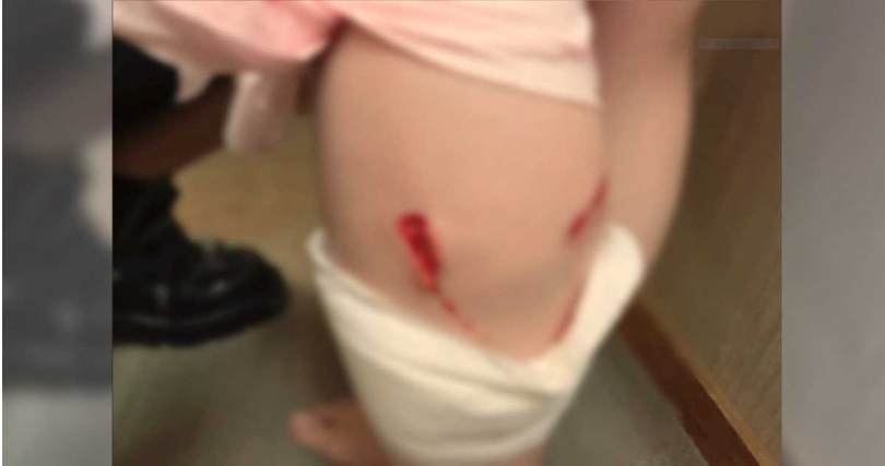 彩瀨千聖被流浪狗攻擊，傷口冒血急送醫。（圖／翻攝自Ｘ／@TJPchihiro）